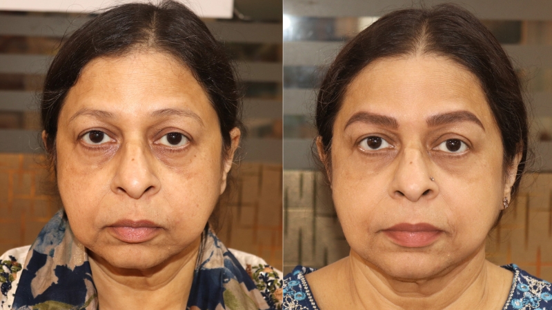 BEFORE & AFTER