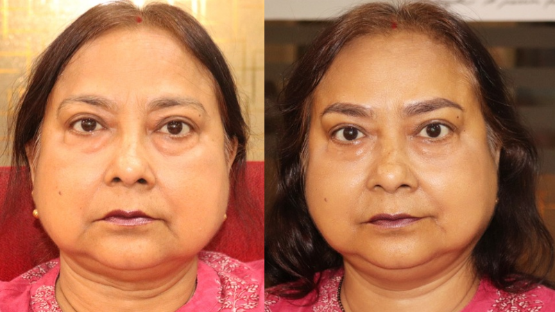 Before - After(1st sitting)